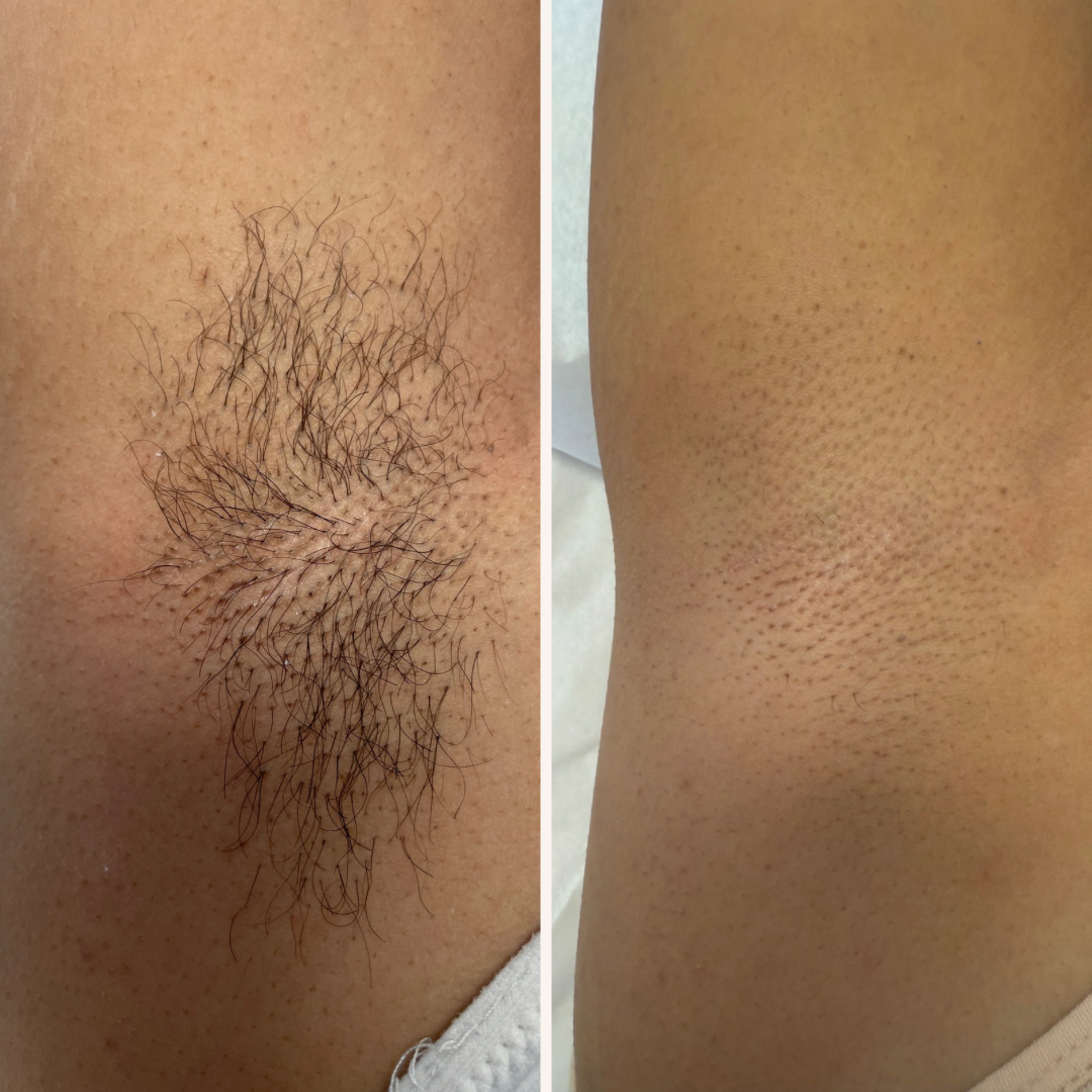 Professional laser session