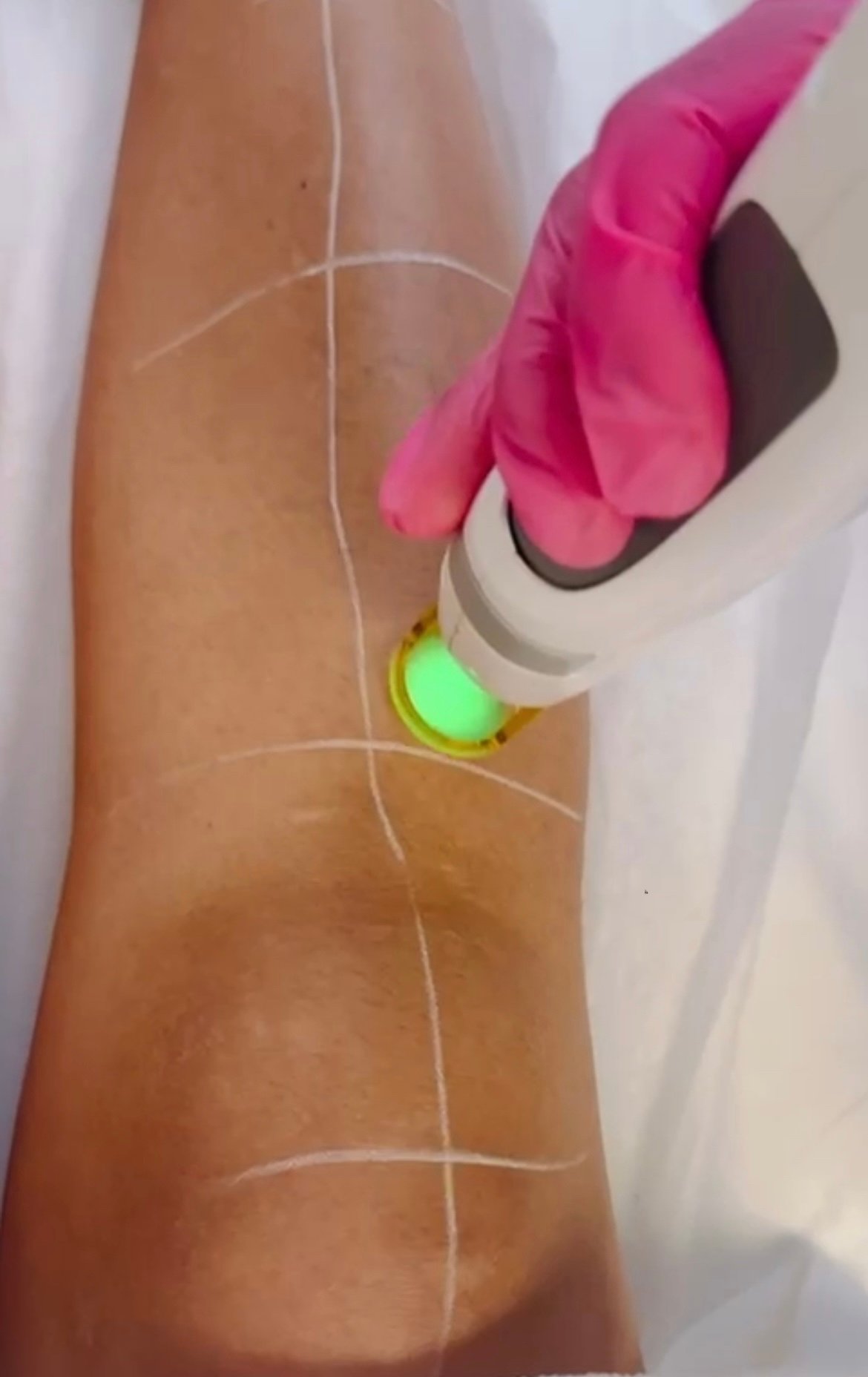 Close-up of laser treatment